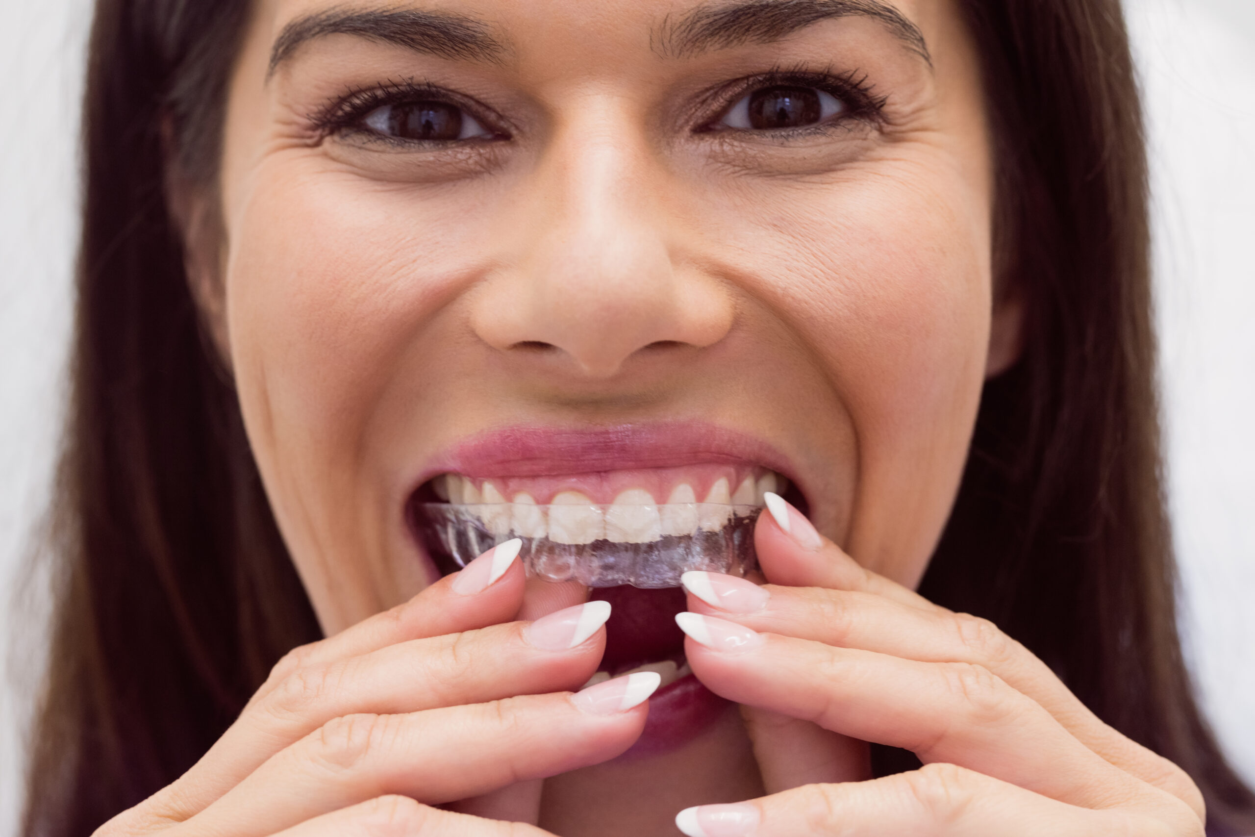 Brackets tradicionales e Invisalign: ¿Cuál es la mejor opción para mí?